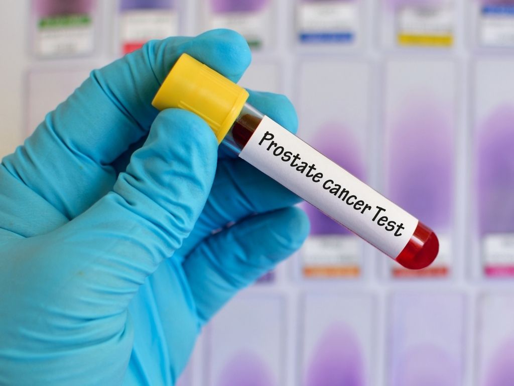 psa test - prostate cancer screening - cyberknife miami